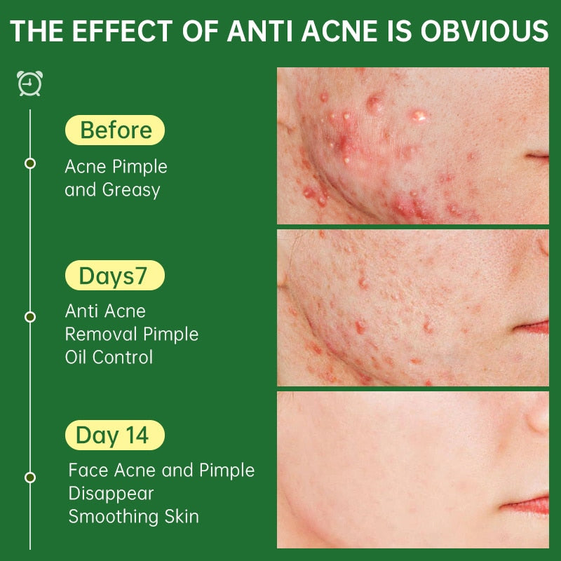 Acne Removal Whitening Cream